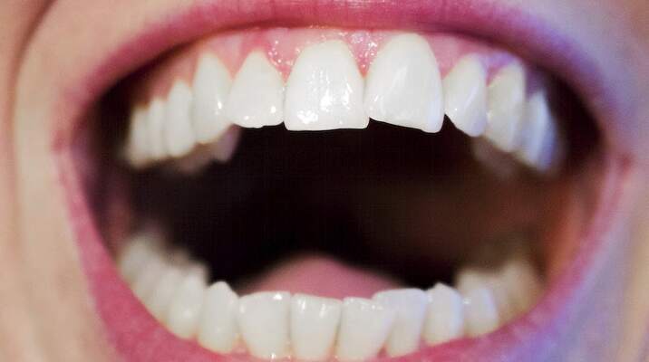 Een mond vol tanden